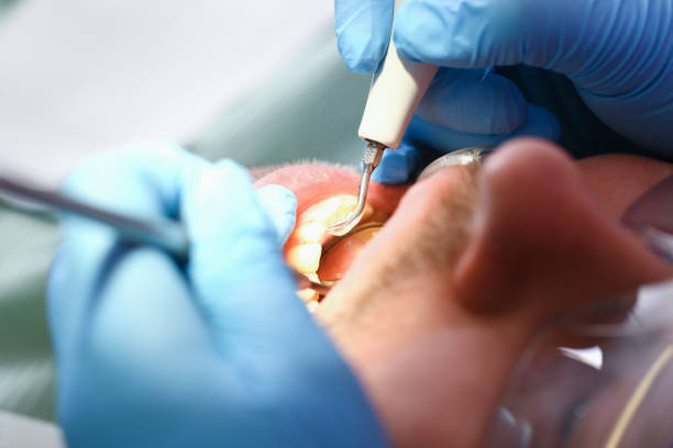 Best Chipped Tooth Repair Near Me  in Zolfo Springs, FL